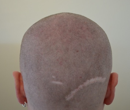 Bild verpfuschter FUT Haartransplantation mit sichelfoermiger_narbe_rasiert