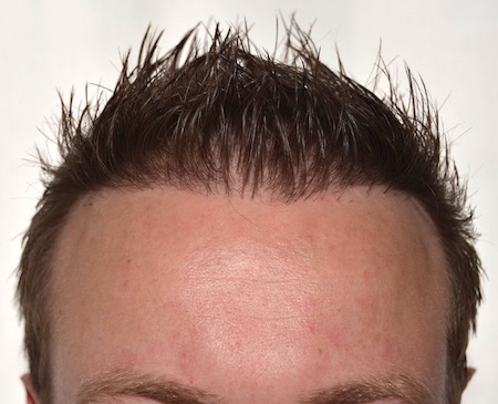 Fall F - Bild nach der Repair-Reparatur Haartransplantation