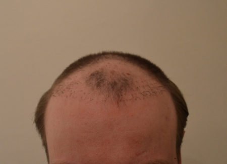Fall F - Bild vor der Repair-Reparatur Haartransplantation