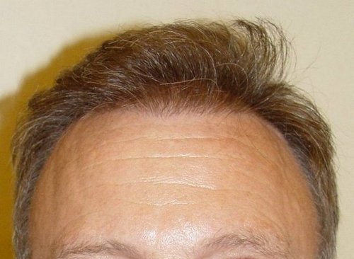Gelungene Haartransplantation Nachher